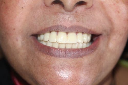 Full Mouth Rehabilitation