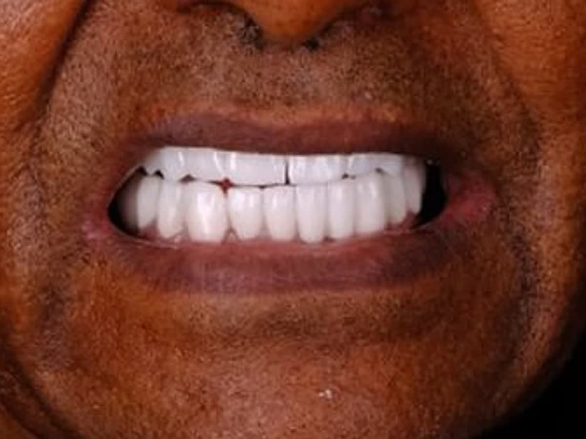 Teeth Whitening