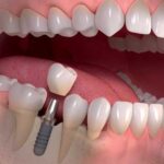 Dental Implants at Basils Dental Clinic - Top Kampala Dentists