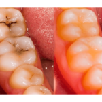 Restorative Dentistry at Basils Dental Clinic - Top Kampala Dentists