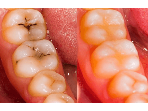 Restorative Dentistry at Basils Dental Clinic - Top Kampala Dentists